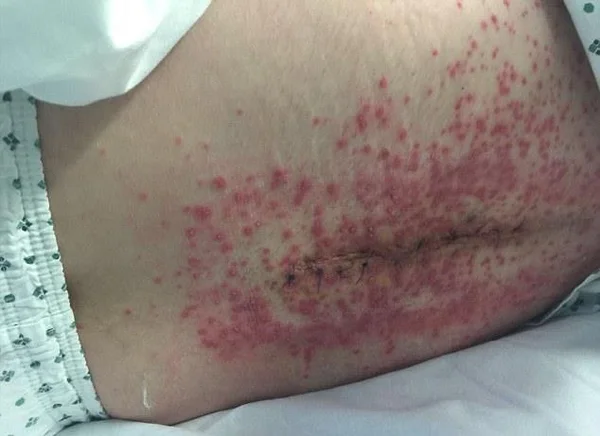 Bebê nasce com pênis extra nas costas e assusta médicos