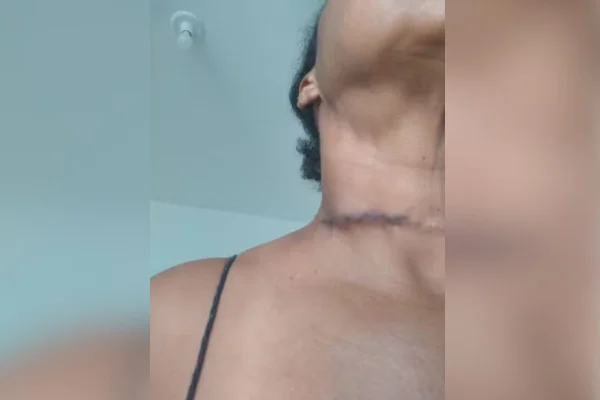 Imagem colorida mostra mulher que teve o pescoço cortado por cerol enquanto andava de bicicleta - Metrópoles
