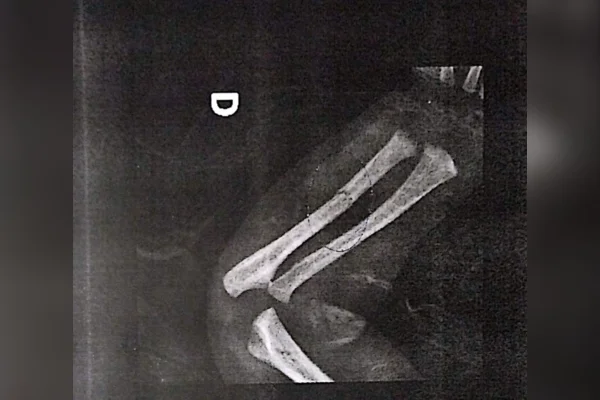 Bebê é levada ao hospital com ossos quebrados e pais são presos - destaque galeria Bebê é levada ao hospital com ossos quebrados e pais são presos - destaque galeria