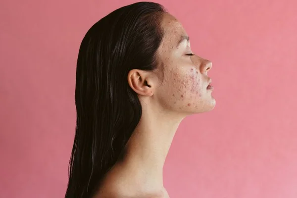 mulher com o rosto cheio de espinhas de olhos fechados - Metropoles