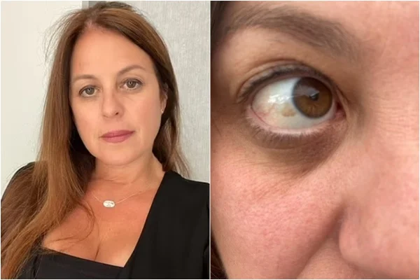 Imagem colorida mostra mulher com mancha marrom no olho