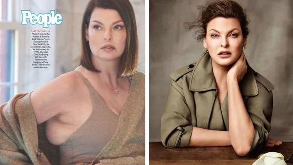 Linda Evangelista: o que fazer se o procedimento estético der errado?