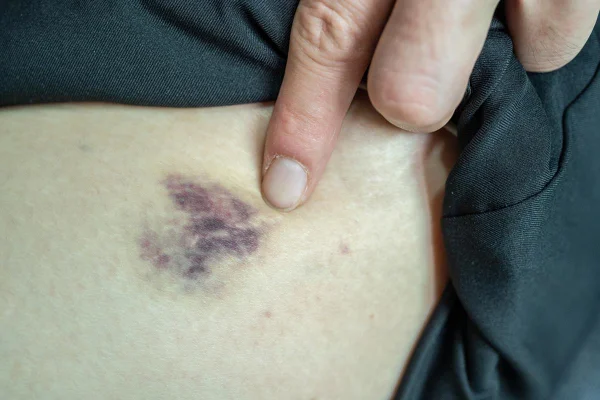 Imagem mostra o dedo de uma pessoa branca apontando para uma mancha roxa na pele - Metrópoles