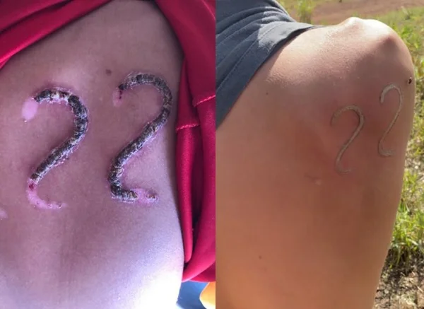Jovem usa ferro em brasa para marcar 22 de Bolsonaro na pele