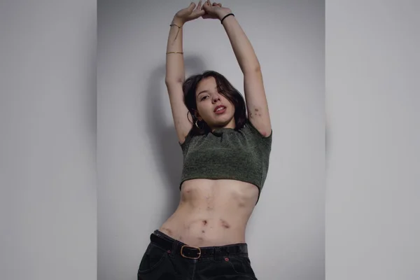 Jovem com hidradenite supurativa com feridas no corpo (3)