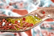 Dentre as doenças cardiovasculares que mais fazem vítimas fatais, o Acidente Vascular Cerebral (AVC) se destaca. Ele é causado devido à presença de placas de gordura que entopem os vasos sanguíneos cerebrais. Entre os sintomas estão: dificuldade para falar, tontura, dificuldade para engolir, fraqueza de um lado do corpo, entre outros