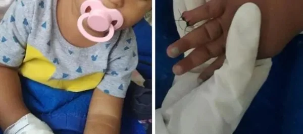 Montagem com o dedo de uma criança que foi amputado por erro médico em São Gonçalo (RJ) - Metrópoles