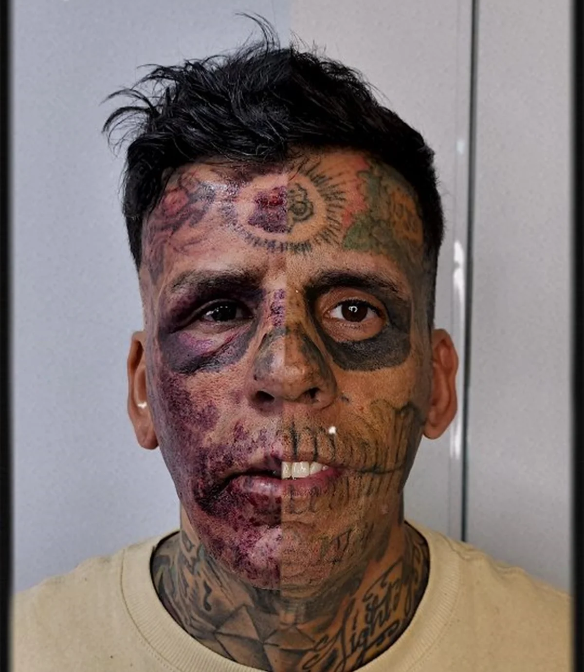 Leandro Souza passou por cirurgias para remover as tatugens Leandro Souza passou por cirurgias para remover as tatugens
