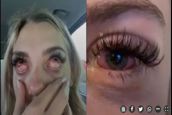 Foto colorida de uma adolescente de 17 anos que ficou com os olhos deformados depois de fazer uma extensão nos cilios