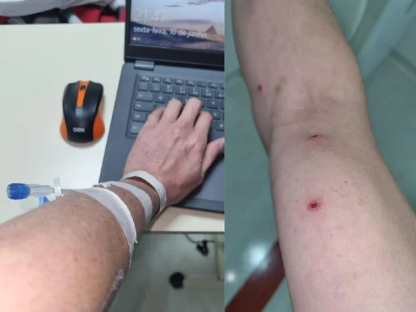 Primeiro brasileiro diagnosticado com varíola dos macacos