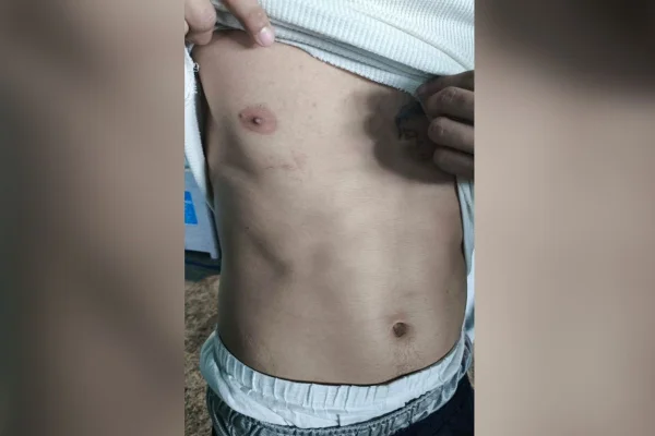 IMAGEM COLORIDA HEMATOMAS DEPORTADOS