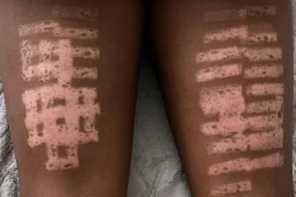Após queimaduras gravíssimas, blogueira expõe riscos da fotodepilação