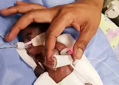 imagem colorida de bebê prematuro segurano a ponta dos dedos de sua mãe - Metrópoles