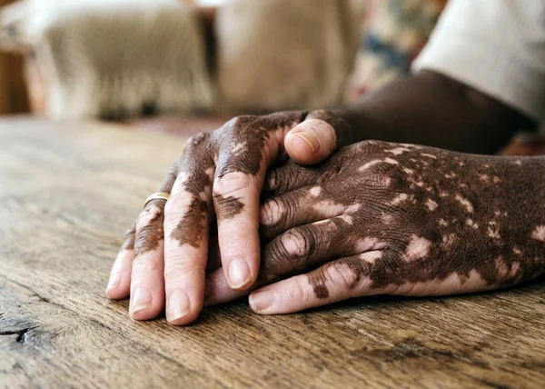 Mãos de pessoa negra com vitiligo - Metrópoles