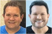 Ximbinha mostra o resultado da harmonização facial