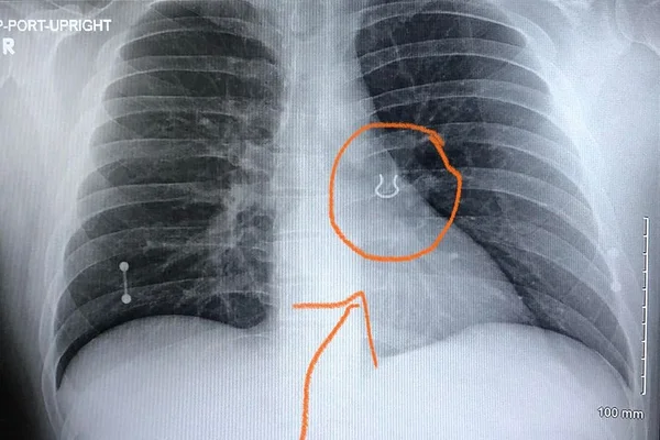 Piercing perdido há cinco anos é encontrado em pulmão de homem