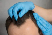 A procura por transplante capilar no Brasil registrou um aumento de 152% A procura por transplante capilar no Brasil registrou um aumento de 152%