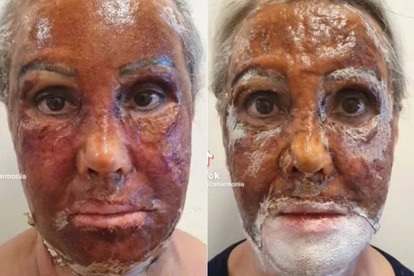Peeling de fenol - tratamento - pele