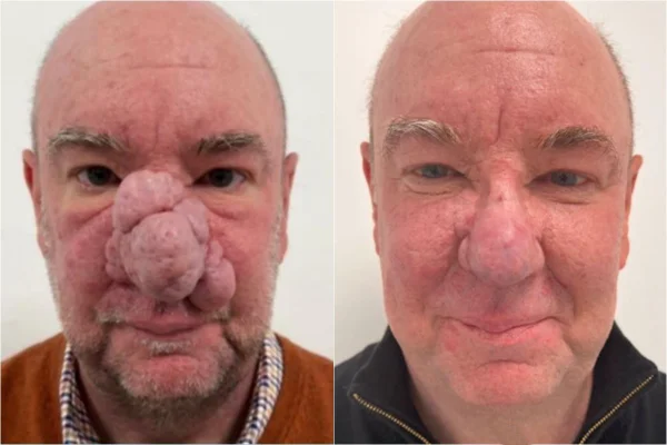 Imagem colorida: antes e depois de homem com anomalia no nariz - Metrópoles