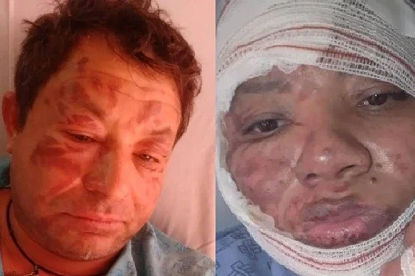 Cantor sertanejo sofre queimaduras graves em todo o corpo após explosão