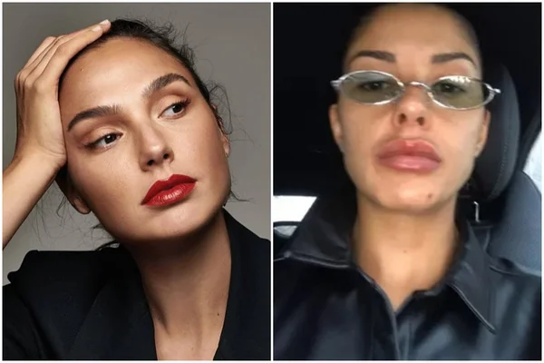 Sósia de Gal Gadot fica com rosto torto após harmonização facial