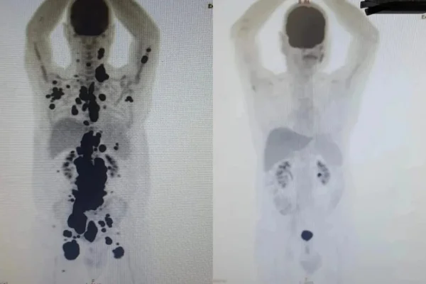 Imagem em preto e branco mostra antes e depois de corpo de paciente com câncer CAR-T - Metrópoles