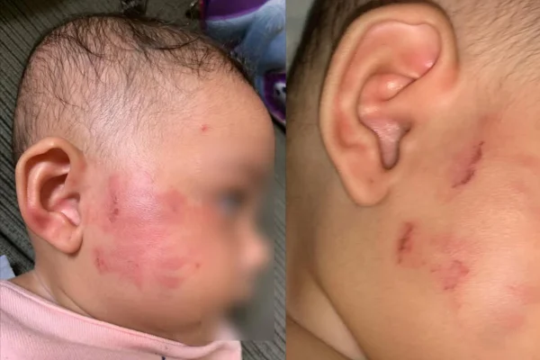 Imagens coloridas de bebê de seis meses que levou mordidas em creche no primeiro dia de aula, em Guarulhos (SP). - Metrópoles