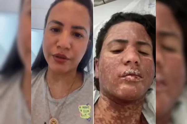 Foto coloridade moça com pele avermelhada devido a síndrome rara