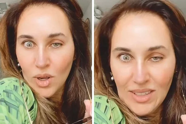 Mulher fica com rosto bizarro após botox atingir a região dos olhos