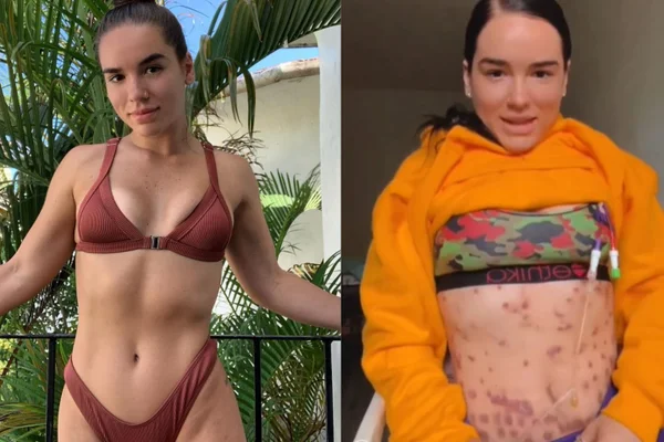 Foto mostra a influencer Bea Amma, que injetou vitaminas para queimar gorduras, mas que foi contaminada com a bacteria comedora de carne, com a qual luta há trÊs anos