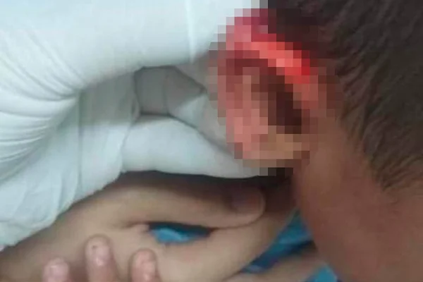 Menino de 3 anos tem orelha cortada com tesoura em creche