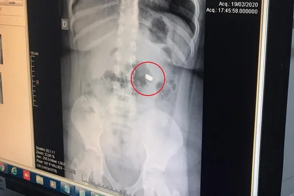 Menina de 7 anos engole bateria e avisa mãe: “Fiquei desesperada”