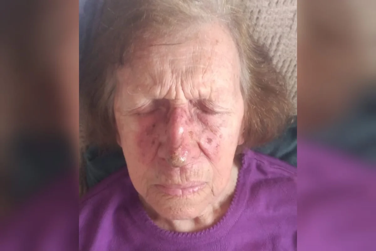 Profundidade da lesão que afetou a ponta do nariz obrigou que o tratamento de Maria Helena não pudesse ser cirúrgico Profundidade da lesão que afetou a ponta do nariz obrigou que o tratamento de Maria Helena não pudesse ser cirúrgico