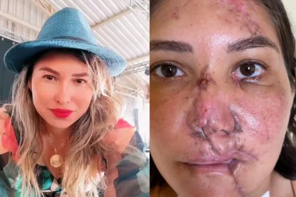 Foto mostra Adriana Costa, mulher que sofreu um acidente de moto e está passando por cirurgias de reconstrução de face