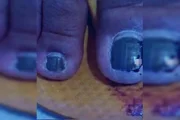 Dedo do pé machucado
