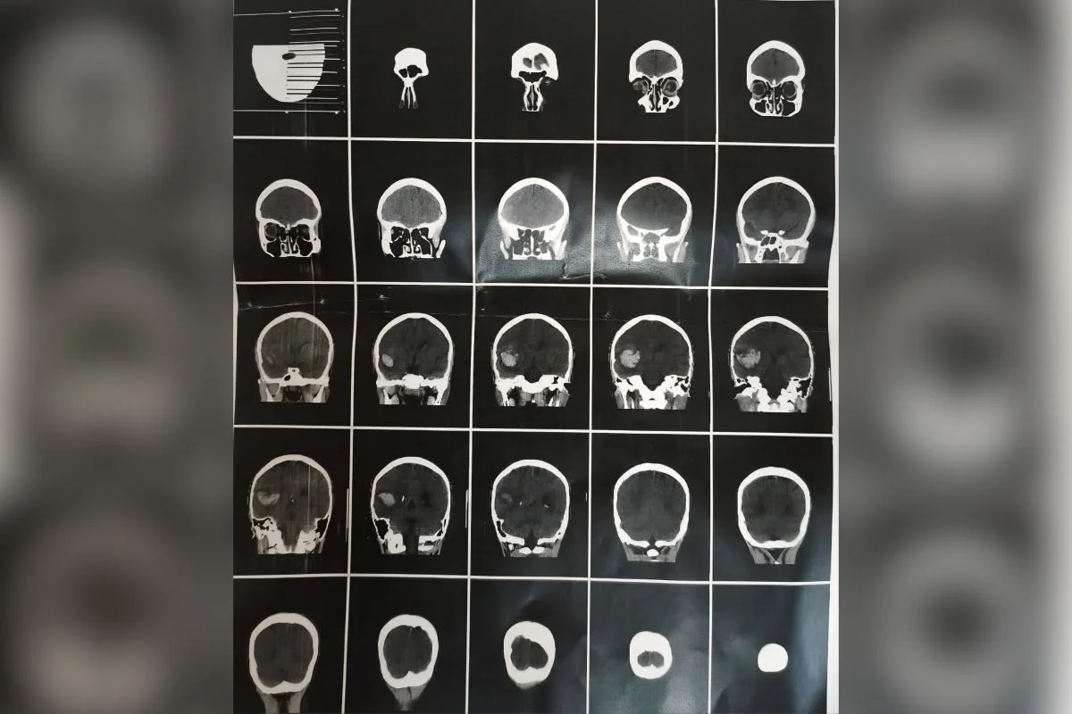 Após o golpe, vítima teve dores de cabeça e passou por exame que constatou lesão intracraniana Após o golpe, vítima teve dores de cabeça e passou por exame que constatou lesão intracraniana