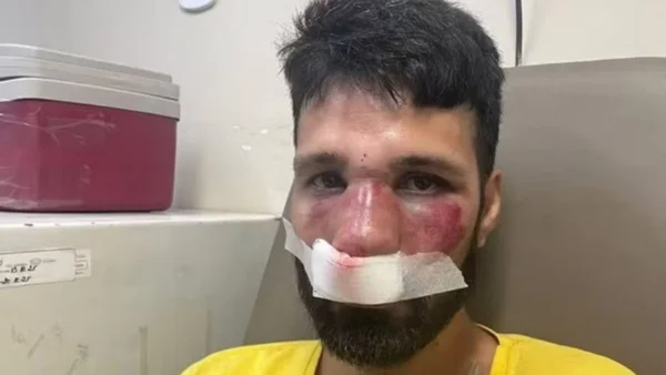 homem com nariz quebrado e inchado