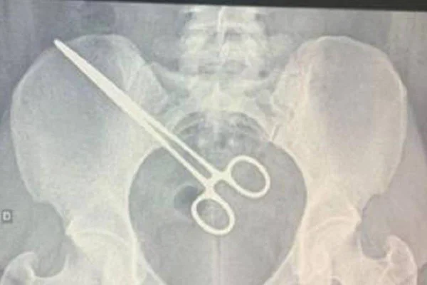 Imagem colorida de pinça médica dentro de mulher