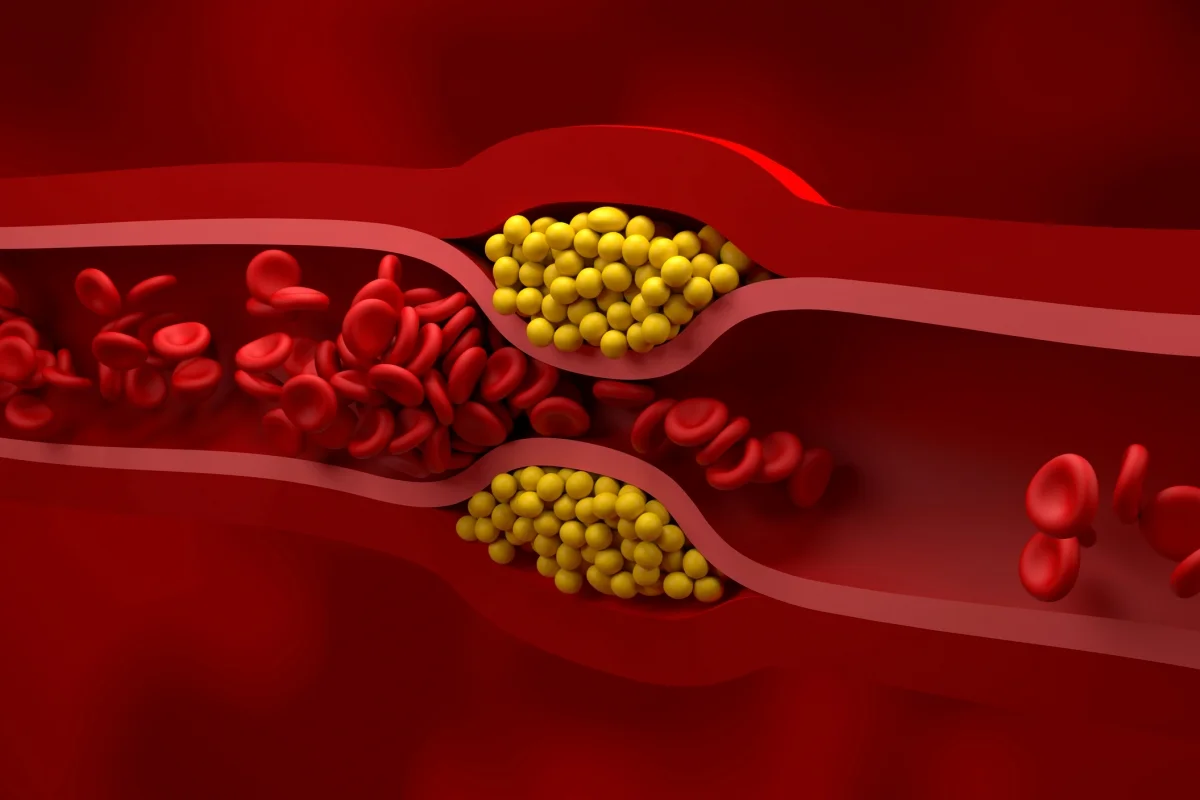 Tratamento de colesterol pode remover PFAS e microplásticos do sangue