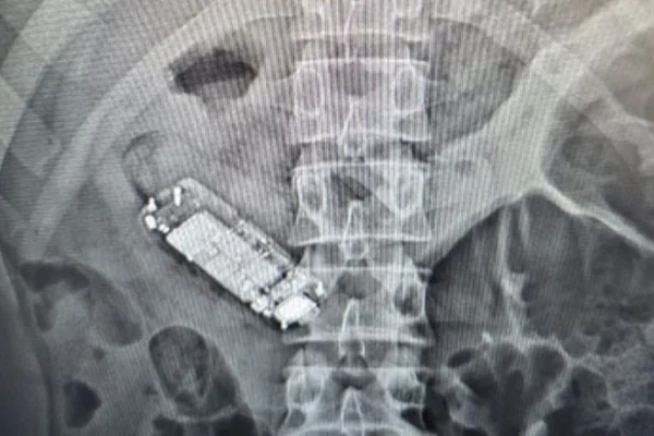 O preso engoliu o aparelho telefonico