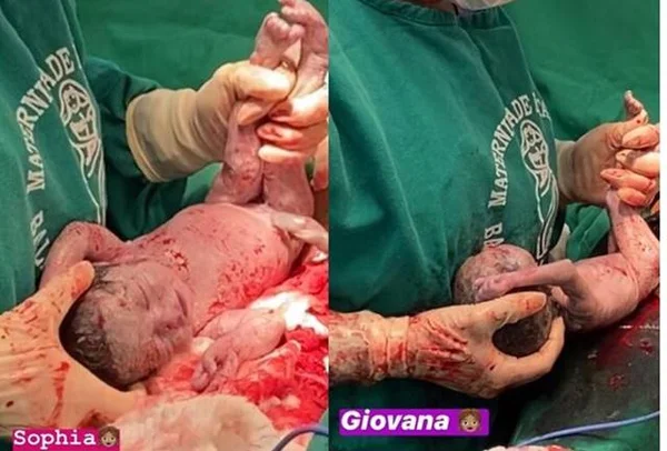 Mãe descobre no parto que carregava quadrigêmeas: “Eu não acreditava”