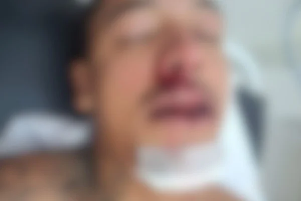 Homem, de 27 anos, fraturou mandíbula, clavícula e perdeu dois dentes. Moradores reclamam de buracos antigos na Brasilândia -Metrópoles