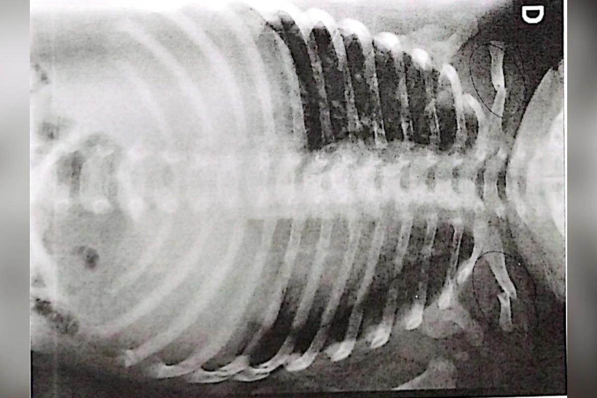 Bebê é levada ao hospital com ossos quebrados e pais são presos - imagem 4 Bebê é levada ao hospital com ossos quebrados e pais são presos - imagem 4