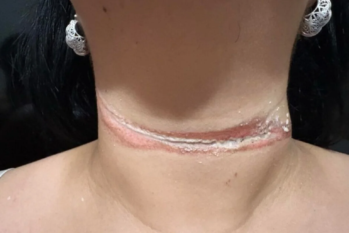 Foto de mulher que quase foi enforcada por fio de internet solto em MS