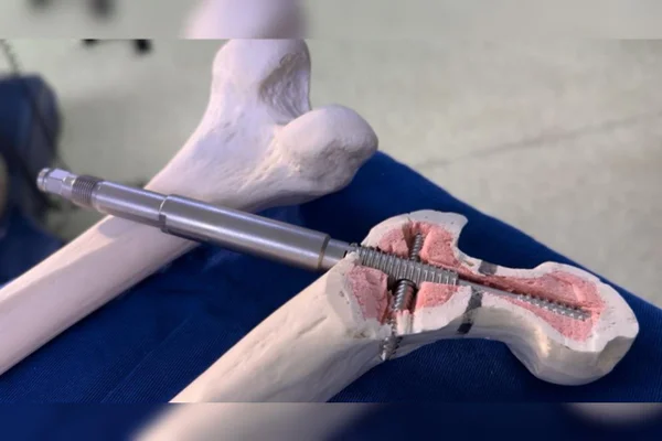 novo implante desenvolvido por médicos brasileiros chama Haste Intramedular Perpendicular Autocompressiva. Metrópoles