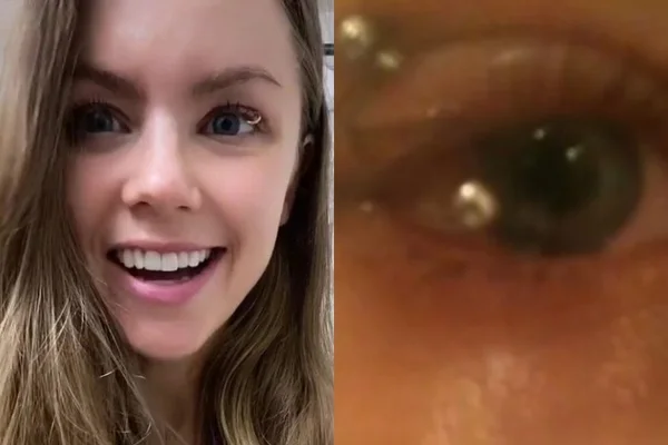 Jovem revolta web ao colocar piercing na pálpebra; médica comenta caso