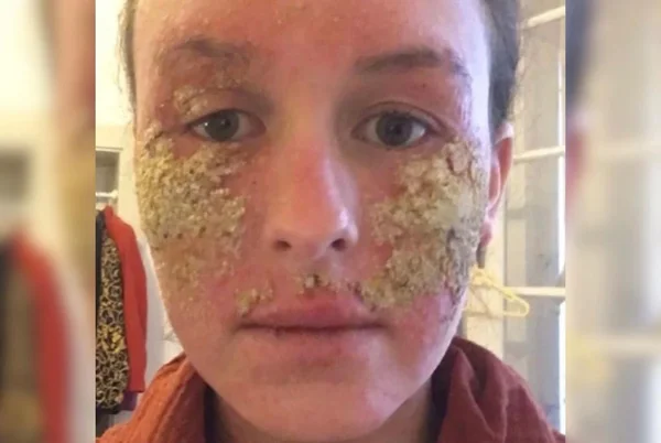 Jovem com eczema