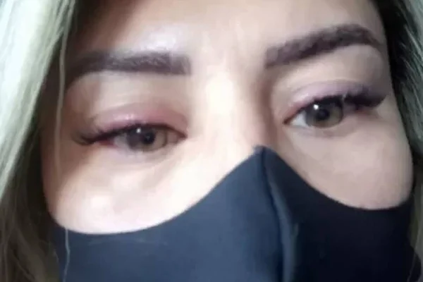 Na foto, uma mulher de máscara preta com olhos inchados - Metrópoles