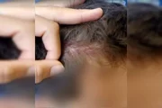 Lesão na cabeça