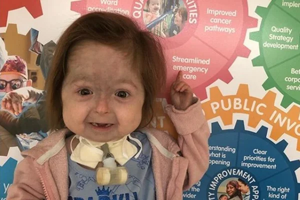 Menina é a única no mundo a ter a doença de Benjamin Button